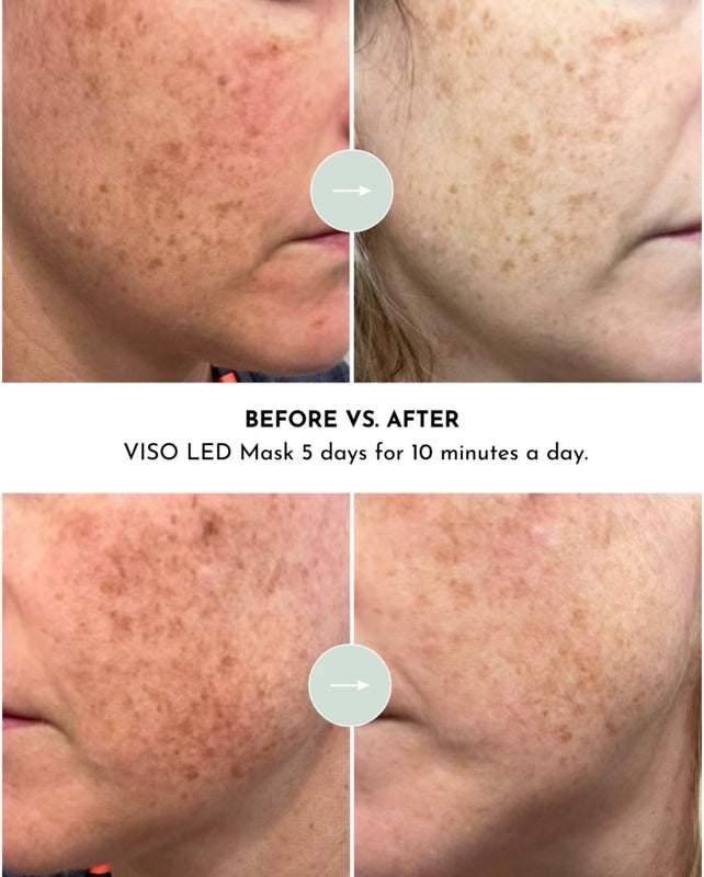 VISO Red Light Therapy Mask
